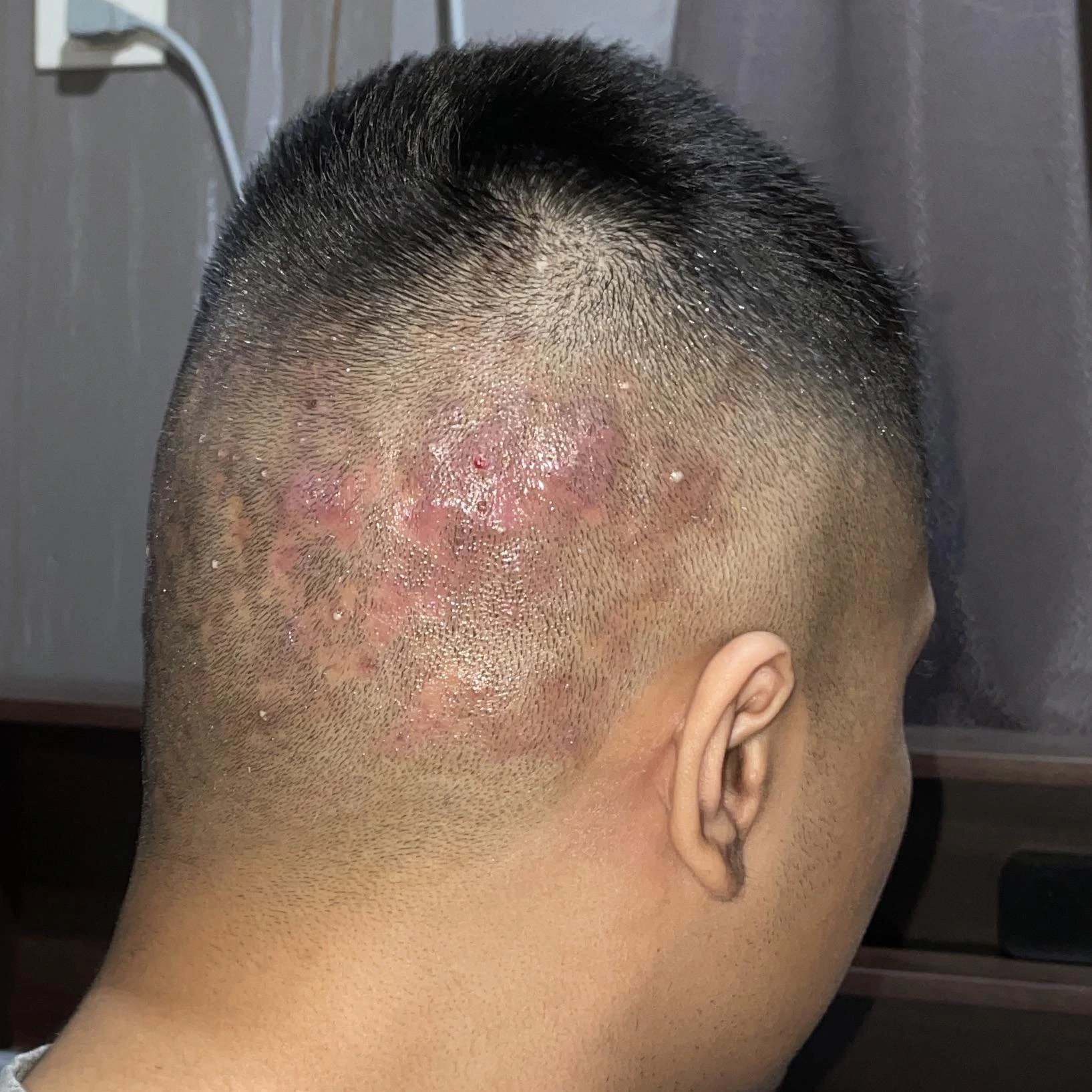 Scalp Inflammation or Redness